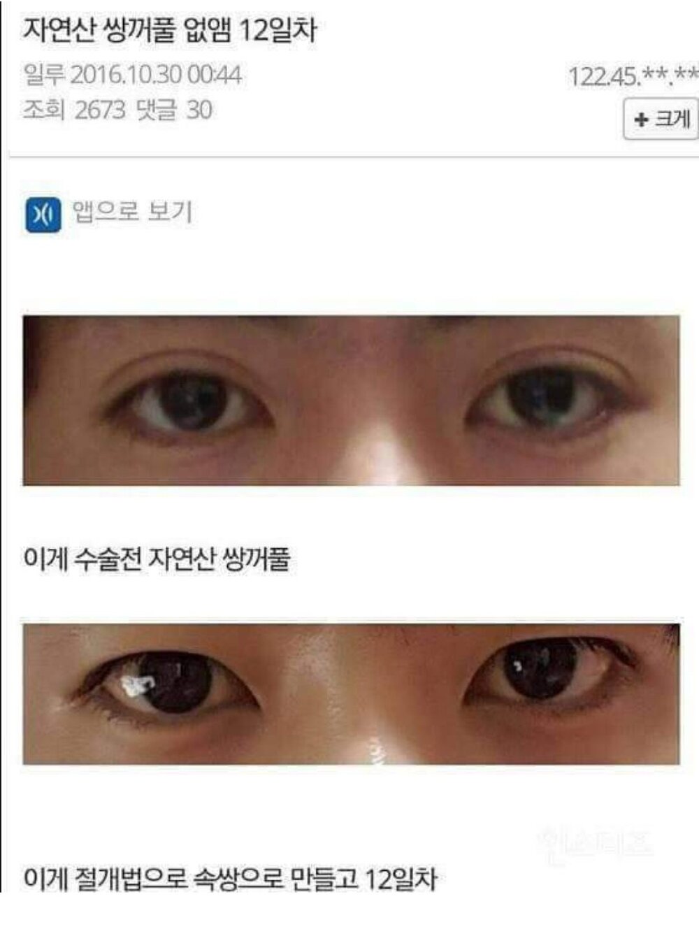 쌍꺼풀 수술 후기 - 에누리 쇼핑지식 자유게시판