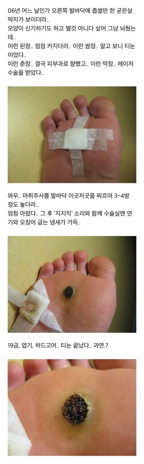 사마귀 완치한 사람의 과정 ㅎㅇㅈㅇ | 인스티즈