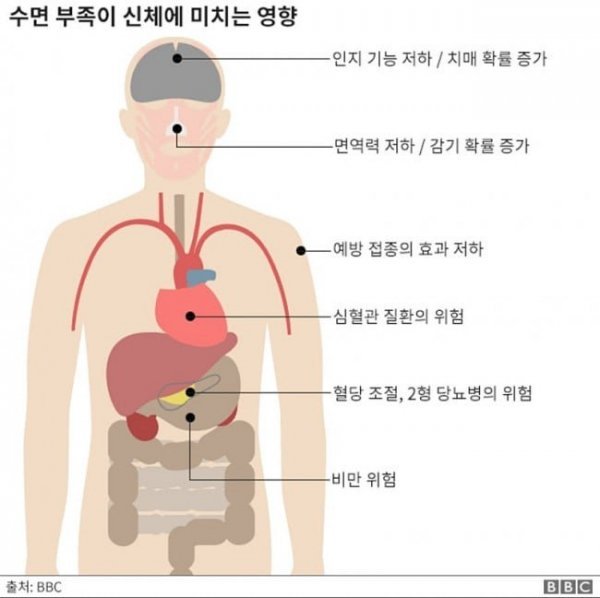 수면부족이 인체에 미치는 영향 | 인스티즈